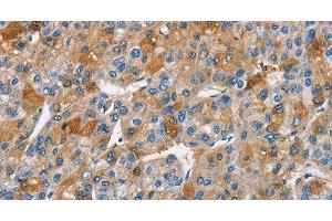 Immunohistochemistry of paraffin-embedded Human liver cancer using BCL10 Polyclonal Antibody at dilution of 1:40 (BCL10 Antikörper)