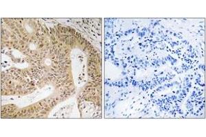Immunohistochemistry analysis of paraffin-embedded human colon carcinoma tissue, using DAP Antibody. (DAP Antikörper  (AA 11-60))