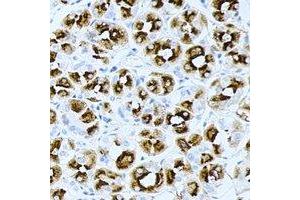 Immunohistochemical analysis of PRG2 staining in human gastric cancer formalin fixed paraffin embedded tissue section.