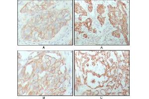 Immunohistochemical analysis of paraffin-embedded human breast carcinoma (A), lung cancer (B) and ovarian cancer tissue (C), showing membrane and cytoplasmic localization with DAB staining using CK8 mouse mAb. (KRT8 Antikörper)