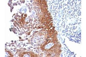 Formalin-fixed, paraffin-embedded human cervical carcinoma stained with Cytokeratin 18 antibody.