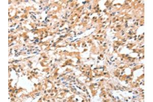 The image on the left is immunohistochemistry of paraffin-embedded Human thyroid cancer tissue using ABIN7128947(CIDEC Antibody) at dilution 1/50, on the right is treated with fusion protein. (CIDEC Antikörper)
