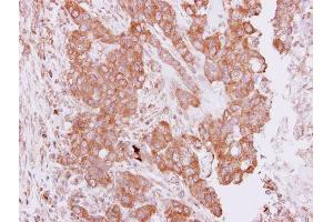 IHC-P Image Immunohistochemical analysis of paraffin-embedded human breast cancer, using PIM2, antibody at 1:250 dilution. (PIM2 Antikörper  (Center))
