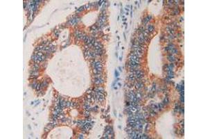 IHC-P analysis of Human Rectum Cancer Tissue, with DAB staining. (Prolactin Receptor Antikörper  (AA 25-234))