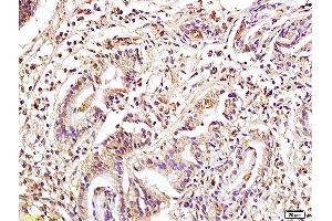 Formalin-fixed and paraffin embedded human colon carcinoma tissue labeled with Anti Phospho-MAP3K8/Tpl2 (Ser400) Polyclonal Antibody, Unconjugated (ABIN746573) at 1:200 followed by conjugation to the secondary antibody and DAB staining. (MAP3K8 Antikörper  (pSer400))