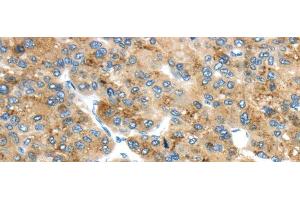 Immunohistochemistry of paraffin-embedded Human liver cancer using TMED4 Polyclonal Antibody at dilution of 1/45 (TMED4 Antikörper)