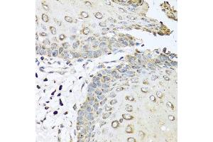 Immunohistochemistry of paraffin-embedded human esophagus using IL6 antibody at dilution of 1:100 (40x lens). (IL-6 Antikörper)