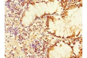 Immunohistochemistry of paraffin-embedded human colon cancer using ABIN7169162 at dilution of 1:100 (PLK3 Antikörper  (AA 487-646))
