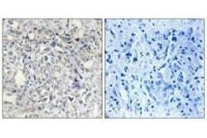 Immunohistochemistry analysis of paraffin-embedded human liver carcinoma tissue, using Heparin Cofactor II antibody. (SERPIND1 Antikörper)