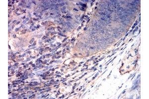 Immunohistochemical analysis of paraffin-embedded rectum cancer tissues using CD163 mouse mAb with DAB staining. (CD163 Antikörper  (AA 42-259))