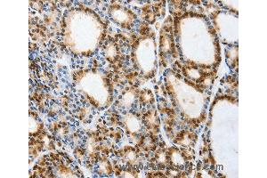 Immunohistochemistry of Human thyroid cancer using VIMP Polyclonal Antibody at dilution of 1:40 (Selenoprotein S Antikörper)