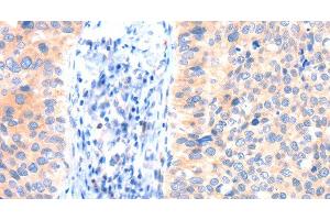 Immunohistochemistry of paraffin-embedded Human cervical cancer tissue using ANK3 Polyclonal Antibody at dilution 1:50 (Ankyrin G Antikörper)