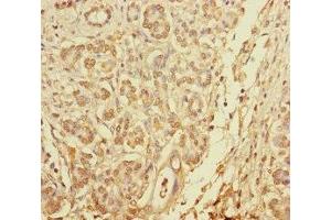 Immunohistochemistry of paraffin-embedded human pancreatic cancer using ABIN7145610 at dilution of 1:100 (Pallidin Antikörper  (AA 1-170))