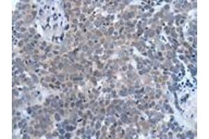 Immunohistochemistry of paraffin-embedded human thyroid cancer using ABIN7190935 at dilution of 1:20 (HES1 Antikörper)