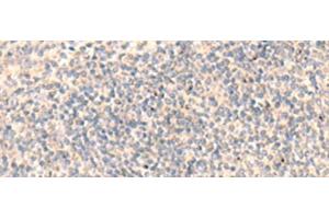 Immunohistochemistry of paraffin-embedded Human tonsil tissue using ADAMTS2 Polyclonal Antibody at dilution of 1:45(x200) (Adamts2 Antikörper)