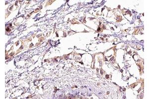 ABIN6267581 at 1/100 staining human breast carcinoma tissue sections by IHC-P. (HSF1 Antikörper  (pSer303))