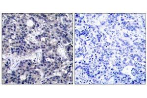 Immunohistochemical analysis of paraffin-embedded human breast carcinoma tissue using PKR (Ab-446) antibody (E021272). (EIF2AK2 Antikörper)