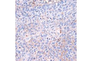 Immunohistochemistry of paraffin-embedded human esophageal cancer using PD-L1/CD274 Rabbit pAb (ABIN6129976, ABIN6138153, ABIN6138154 and ABIN6215142) at dilution of 1:100 (40x lens). (PD-L1 Antikörper  (AA 19-238))
