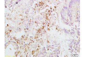 Formalin-fixed and paraffin embedded human rectal carcinoma labeled with Anti-Integrin beta 3/CD61 Polyclonal Antibody, Unconjugated  at 1:200, followed by conjugation to the secondary antibody and DAB staining