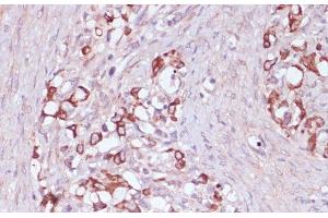 Immunohistochemistry of paraffin-embedded Human oophoroma using UGT2B15 Polyclonal Antibody at dilution of 1:100 (40x lens). (UGT2B15 Antikörper)