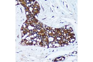 Immunohistochemistry of paraffin-embedded Human breast cancer using MRPL30 Rabbit pAb (ABIN7268567) at dilution of 1:100 (40x lens). (MRPL30 Antikörper  (AA 1-161))