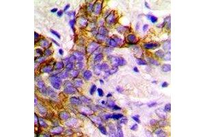 Immunohistochemical analysis of GABARAP staining in human breast cancer formalin fixed paraffin embedded tissue section. (GABARAP Antikörper)