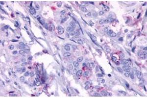 Immunohistochemistry (Formalin/PFA-fixed paraffin-embedded sections) of human colon cancer, neoplastic cells with GPR124 polyclonal antibody . (GPR124 Antikörper  (Extracellular Domain))