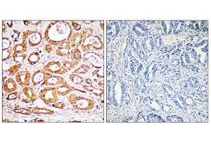 Immunohistochemistry analysis of paraffin-embedded human colon carcinoma tissue, using RPS19 antibody. (RPS19 Antikörper  (Internal Region))