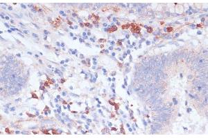 Immunohistochemistry of paraffin-embedded Human colon carcinoma using VASP Polyclonal Antibody at dilution of 1:100 (40x lens).