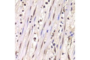 Immunohistochemistry of paraffin-embedded human mammary cancer using LSM4 antibody. (LSM4 Antikörper  (AA 1-139))