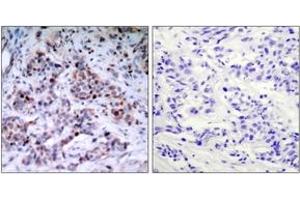 Immunohistochemistry analysis of paraffin-embedded human breast carcinoma, using NF-kappaB p65 (Phospho-Thr435) Antibody. (NF-kB p65 Antikörper  (pThr435))