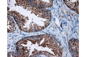 Immunohistochemical staining of paraffin-embedded Carcinoma of liver tissue using anti-FAHD2A mouse monoclonal antibody. (FAHD2A Antikörper)