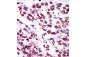 Formalin-fixed and paraffin-embedded human cancer tissue reacted with the primary antibody, which was peroxidase-conjugated to the secondary antibody, followed by AEC staining. (PKC epsilon Antikörper  (N-Term))