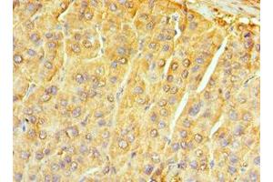 Immunohistochemistry of paraffin-embedded human liver cancer using ABIN7161741 at dilution of 1:100 (NTRK3 Antikörper  (AA 40-300))