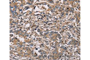 Immunohistochemistry of Human liver cancer using HSD17B12 Polyclonal Antibody at dilution of 1:30