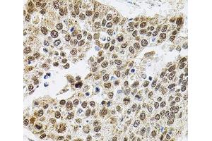 Immunohistochemistry of paraffin-embedded Human lung cancer using BAF60a Polyclonal Antibody at dilution of 1:100 (40x lens).