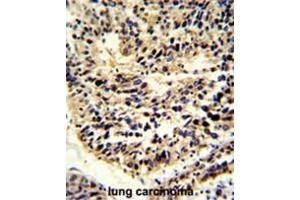 Formalin-fixed and paraffin-embedded human lung carcinoma reacted with BCL2A1 Antibody (Center), which was peroxidase-conjugated to the secondary antibody, followed by DAB staining. (BCL2A1 Antikörper  (Middle Region))