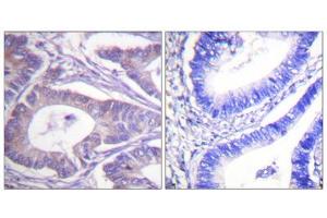Immunohistochemistry analysis of paraffin-embedded human colon carcinoma tissue, using Vimentin antibody. (Vimentin Antikörper  (C-Term))