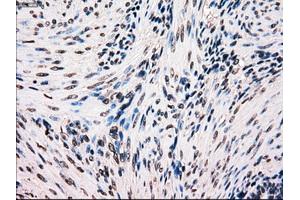 Immunohistochemical staining of paraffin-embedded Carcinoma of kidney tissue using anti-BRAFmouse monoclonal antibody. (BRAF Antikörper)