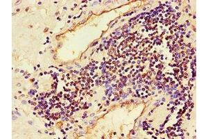 Immunohistochemistry of paraffin-embedded human prostate cancer using ABIN7160009 at dilution of 1:100 (JNK Antikörper  (AA 5-300))