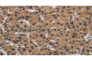Immunohistochemistry of paraffin-embedded Human liver cancer tissue using Claudin 2 Polyclonal Antibody at dilution 1:50 (Claudin 2 Antikörper)