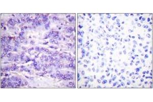 Immunohistochemistry analysis of paraffin-embedded human breast carcinoma, using MDM2 (Phospho-Ser166) Antibody.