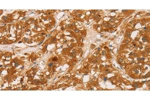 Immunohistochemistry of paraffin-embedded Human thyroid cancer tissue using CD43 Polyclonal Antibody at dilution 1:60 (CD43 Antikörper)
