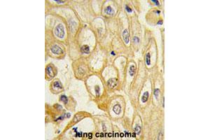 Formalin-fixed and paraffin-embedded human lung carcinomareacted with ROR1 polyclonal antibody , which was peroxidase-conjugated to the secondary antibody, followed by AEC staining. (ROR1 Antikörper  (AA 112-399))