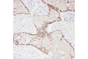 Anti- CD62P antibody, IHC(P) IHC(P): Human Mammary Cancer Tissue