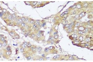 Immunohistochemistry of paraffin-embedded Human liver cancer using FKBP10 Polyclonal Antibody at dilution of 1:150 (40x lens). (FKBP10 Antikörper)