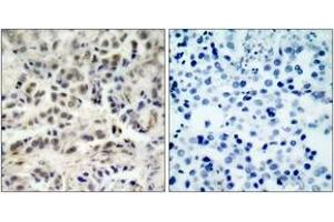 Immunohistochemistry analysis of paraffin-embedded human lung carcinoma tissue, using p27 Kip1 (Ab-10) Antibody. (CDKN1B Antikörper  (AA 1-50))