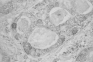 IHC on human uterine cervical adenocarcinoma (RCAS1 Antikörper)