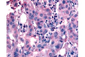 Anti-NANP antibody IHC of human Breast, Carcinoma. (NANP Antikörper  (Internal Region))