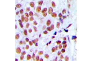 Immunohistochemical analysis of hnRNP L staining in human breast cancer formalin fixed paraffin embedded tissue section. (HNRNPL Antikörper)